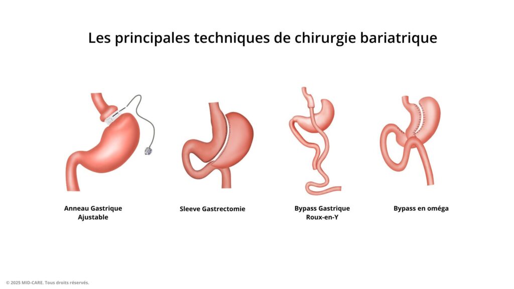 Tout savoir sur l’obésité : causes, conséquences et traitements disponibles 3 techniques chirurgie bariatrique mid care 3