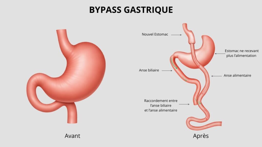 Bypass : Tout savoir sur le bypass gastrique 2 BIBLIOTHEQUE DE PICTOGRAMMES 1200 x 675 px 1 1 1