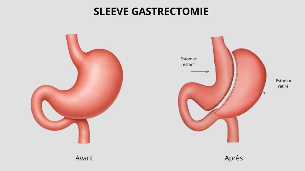 Sleeve : tout savoir sur la sleeve gastrectomie 2 BIBLIOTHEQUE DE PICTOGRAMMES 1200 x 675 px 1 1